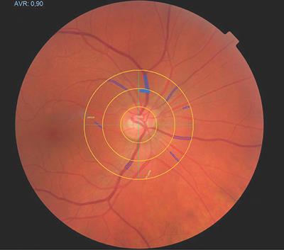 Retinal Vessel Diameters and Physical Activity in Patients With Mild to Moderate Rheumatic Disease Without Cardiovascular Comorbidities